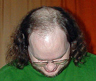 Male pattern Baldness.jpg