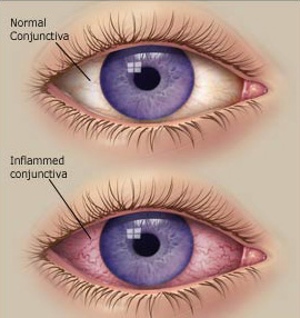 Conjunctivitis.jpg