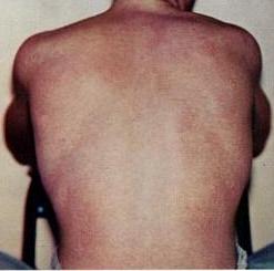 صورة لظهر شخص يظهر عليه طفح جلدي نتيجة الإصابة بحمى الدنگ.