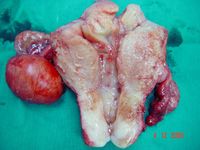 Fibroids, Ovarian Cyst; Panhysterectomy.jpg