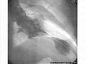 Left ventriculogram during systole displaying the characteristic apical ballooning with apical motionlessness in a patient with takotsubo cardiomyopathy
