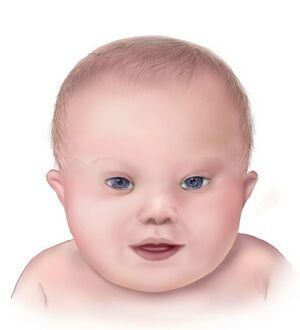 Illustration of the facial features of Down syndrome