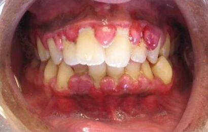 Gingivitis (crop).jpg