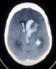 Intracerebral heamorrage 2.jpg