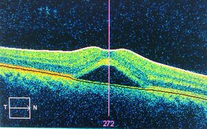 Central serous retinopathy.jpg