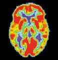 مسح PET لمخ غير مصاب - الصورة مقدمة من مركز الإحالة والتوعية بمرض ألزايمر التابع للمعهد الوطني للشيخوخة بالولايات المتحدة.