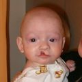 3 month old boy before going into surgery to have his unilateral incomplete cleft lip repaired.