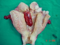 Fibroids; Myomectomy 9.jpg