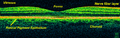 OCT في المجال الزمني للمنطقة البقعية لشبكية العين عند 800   نانومتر ، القرار المحوري 3   µ م