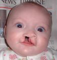 6 month old girl before going into surgery to have her unilateral complete cleft lip repaired.