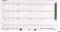 ECG showing sinus tachycardia and non-specific ST and T wave changes from a person with confirmed takotsubo cardiomyopathy