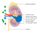 Stage 3 kidney cancer