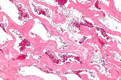 Cavernous liver hemangioma - intermed mag.jpg