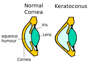 Keratoconus.svg