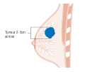 المرحلة 2 من سرطان الثدي.