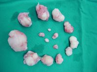 Multiple Fibroids, Myomectomy 3 (16).jpg