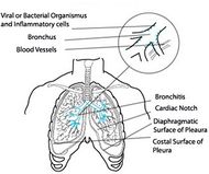 Acute-bronchitis.jpg