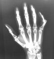 X-ray of right little finger dislocation