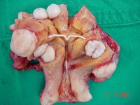 Multiple Fibroids, Panhysterectomy; IUD in uterine cavity.jpg