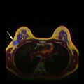 تصوير بالرنين المغناطيسي يظهر سرطان الثدي.