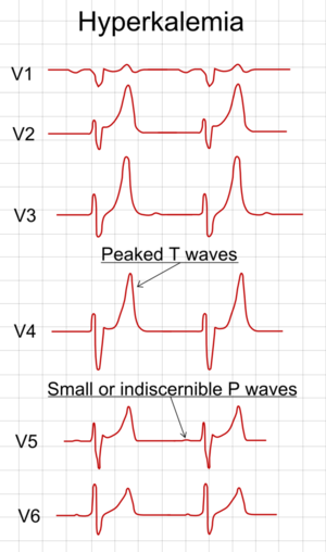 ECG in hyperkalemia.png