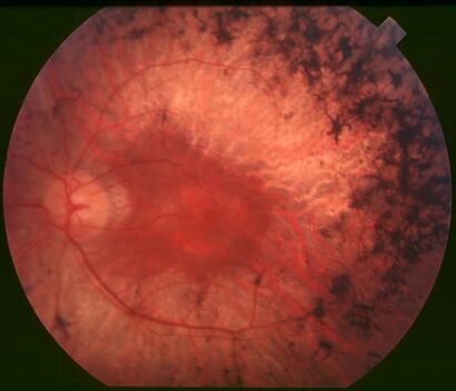 Fundus of patient with retinitis pigmentosa, mid stage.jpg