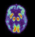 مسح PET لمخ مصاب بمرض ألزايمر - الصورة مقدمة من مركز الإحالة والتوعية بمرض ألزايمر التابع للمعهد الوطني للشيخوخة بالولايات المتحدة.