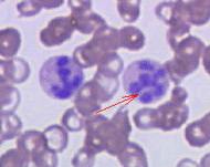 Hypersegmented neutrophil.png