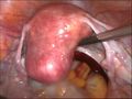 uterus before hysterectomy