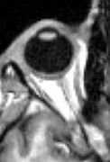 مسح التصوير بالرنين المغناطيسي للعين البشرية تظهر العدسة.