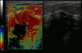 يُظهر التصوير الإلستوجرافي أنسجة سرطانية شديدة في التصوير بالموجات فوق الصوتية.
