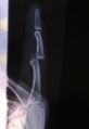 X-ray of left index finger dislocation