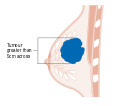 المرحلة 3 من سرطان الثدي.