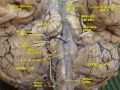 Cerebrum. Inferior view. Deep dissection.