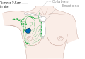 المرحلة 2A من سرطان الثدي.