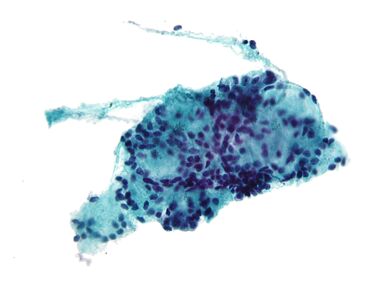 Adenoid cystic carcinoma cytology.jpg