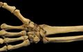 Right Human Anterior Distal Radius, Ulna, Carpals