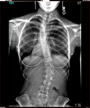 Amanda-Scoliosis.JPG