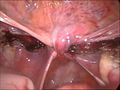 end of an laparoscopical hysterectomy