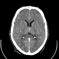 Computed tomography of brain of Mikael Häggström (17).png