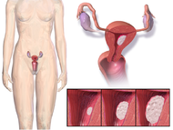 Blausen 0348 EndometrialCancer.png