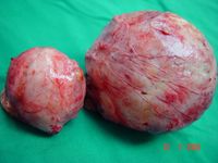 Multiple Fibroids; Total Hysterectomy 19.jpg