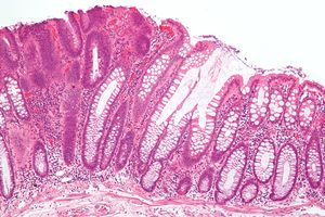 Tubular adenoma 2 intermed mag.jpg