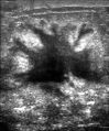 تظهر صورة الموجات فوق الصوتية كتلة غير منتظمة الشكل من سرطان الثدي.