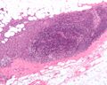 صورة مجهرية تظهر غزو العقد الليمفاوي بسرطان الثدي القنوي، مع امتداد الورم إلى ما وراء العقدة الليمفاوية.
