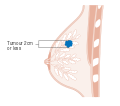 المرحلة 1 من سرطان الثدي.