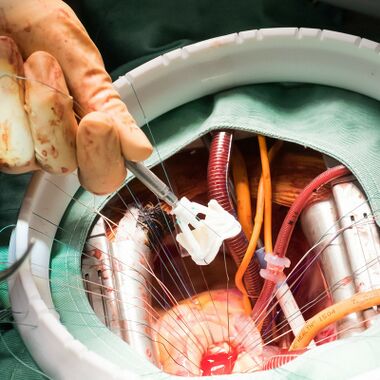 Heart valve replacement.jpg