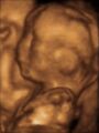 Fetus at 20 weeks