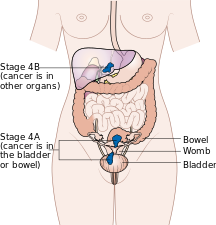 المرحلة الرابعة من سرطان بطانة الرحم.