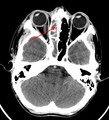 A computed tomograph showing infection of the ethmoid sinus